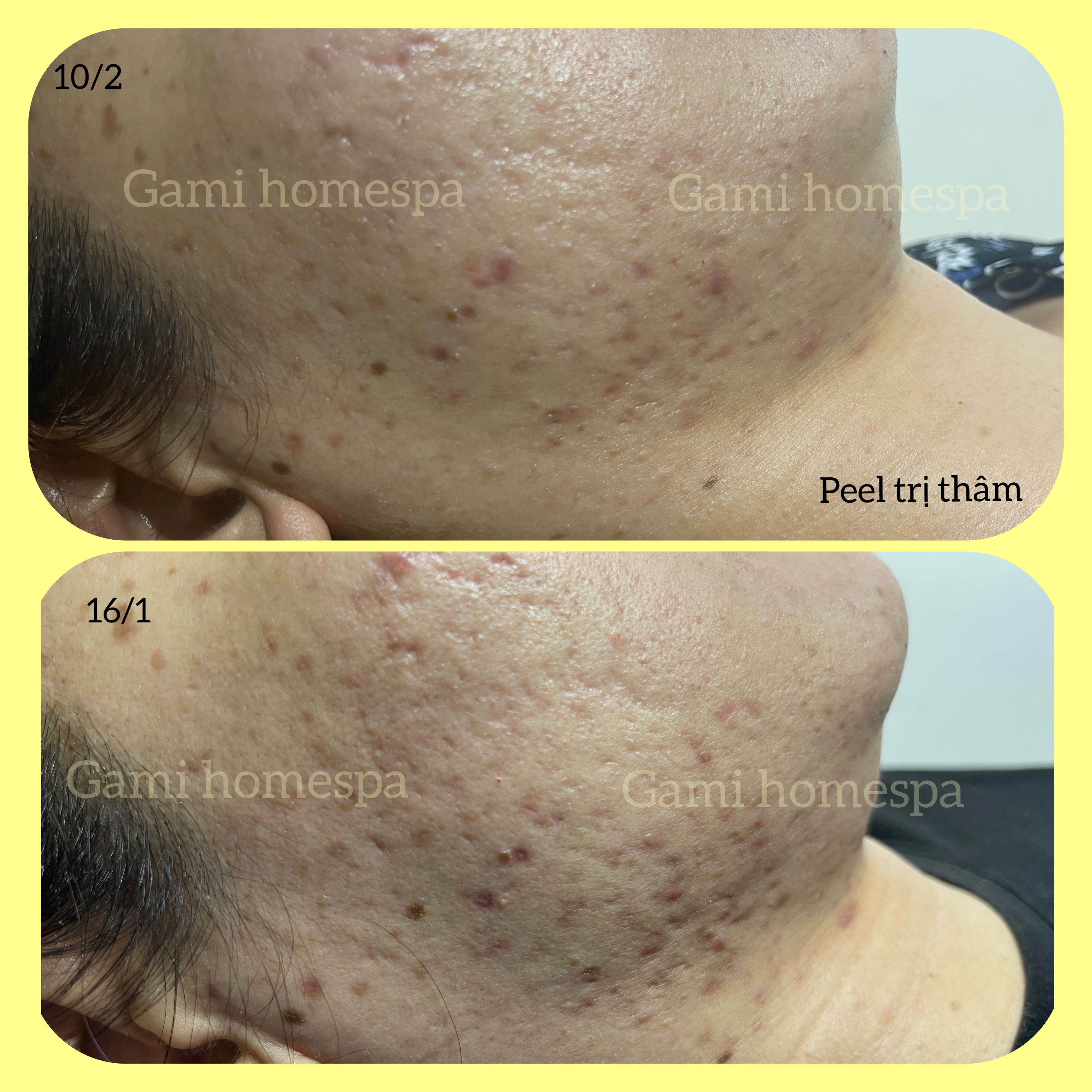 trị mụn tại nhà Anspa