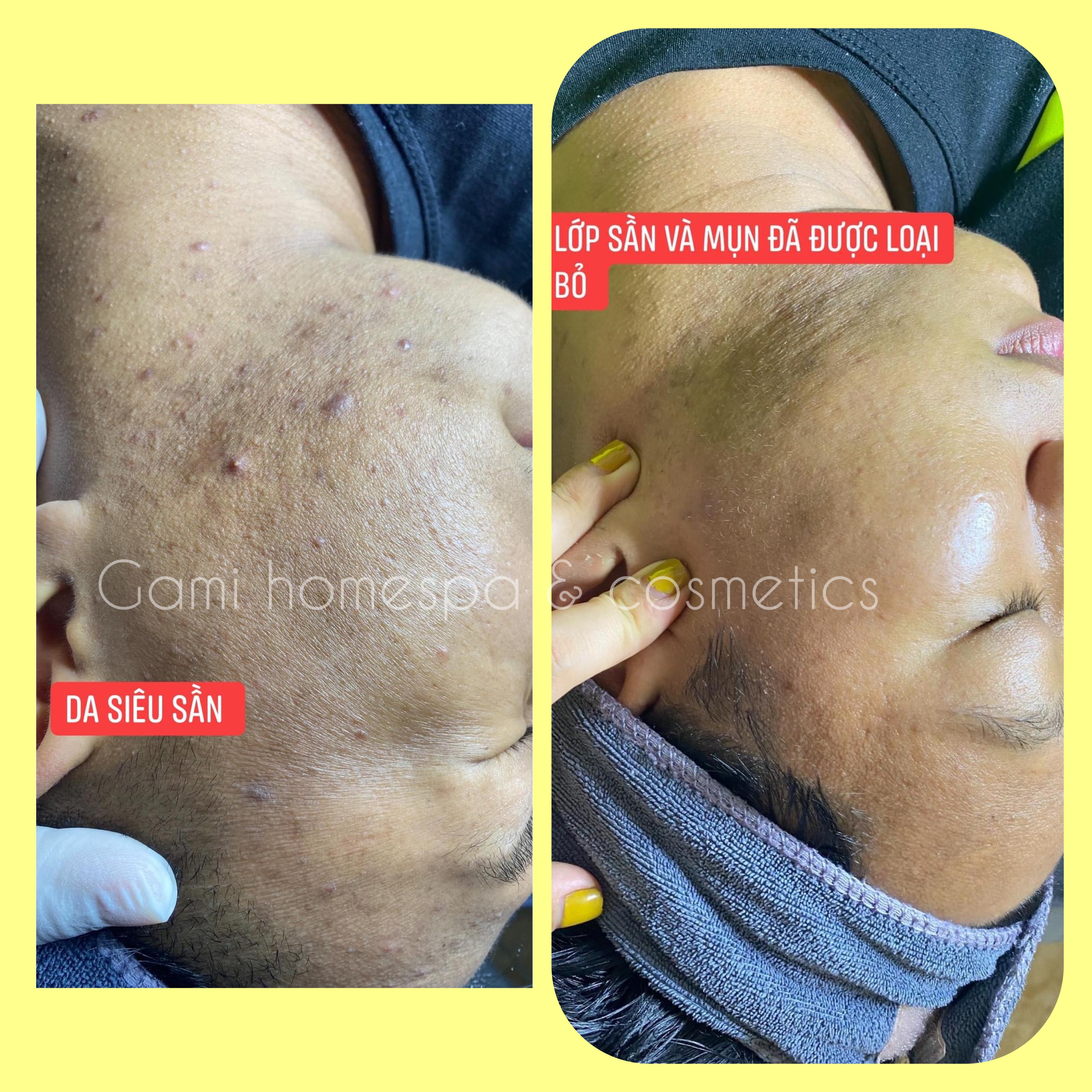trị mụn tại nhà Anspa