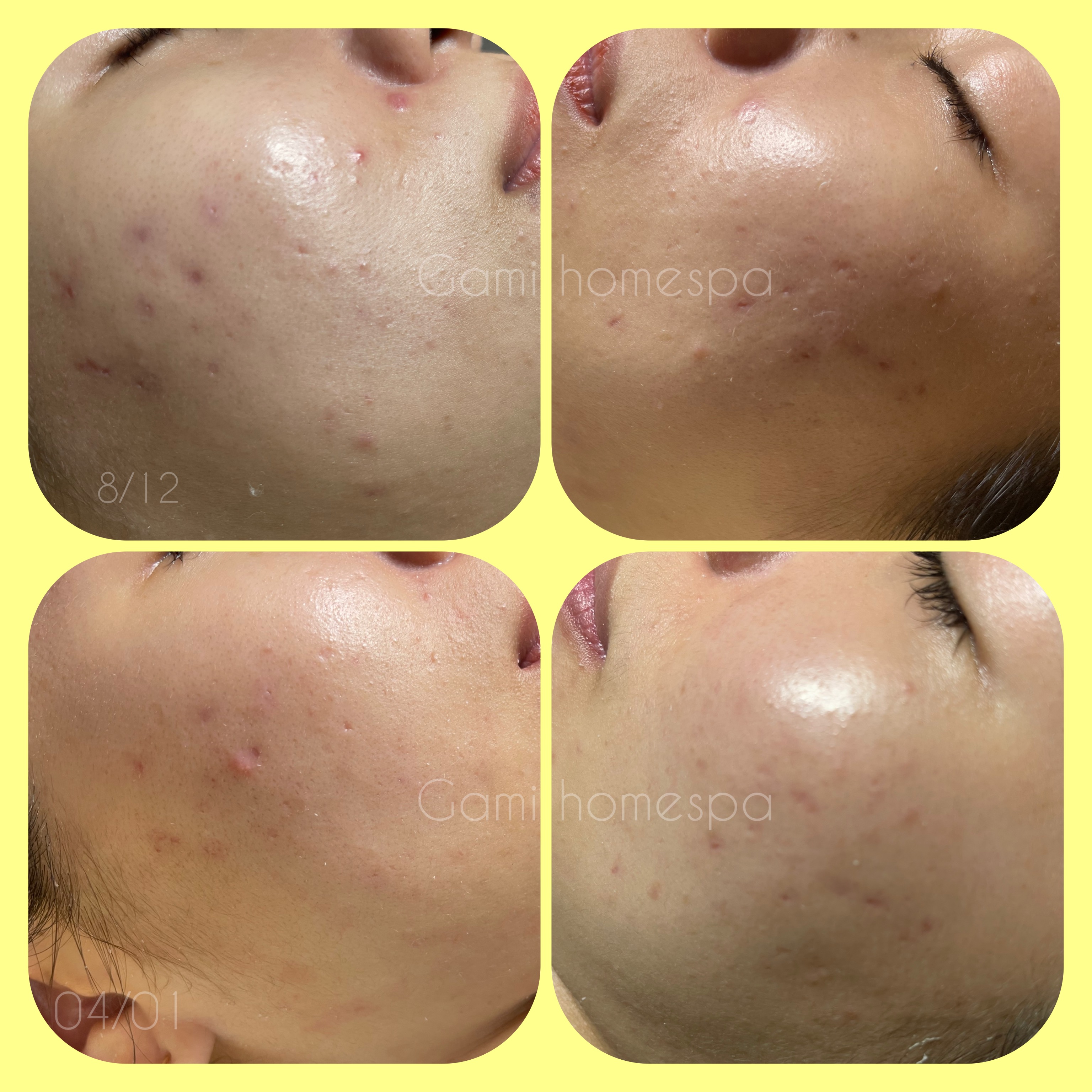 trị mụn tại nhà Anspa